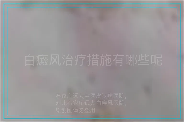 白癜风治疗措施有哪些呢