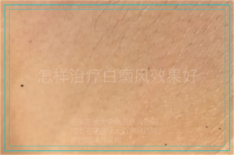 怎样治疗白癜风效果好