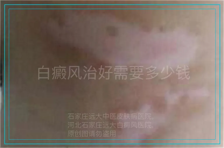 白癜风治好需要多少钱