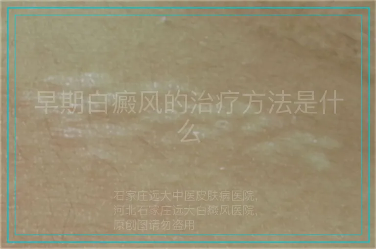早期白癜风的治疗方法是什么
