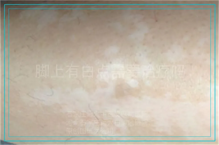 脚上有白点需要治疗吗