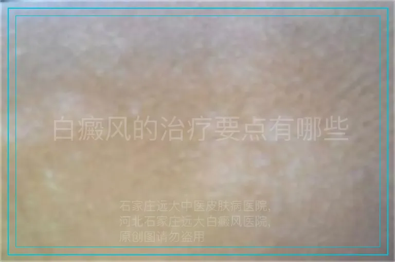 白癜风的治疗要点有哪些