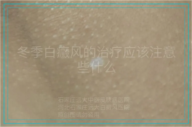 冬季白癜风的治疗应该注意些什么