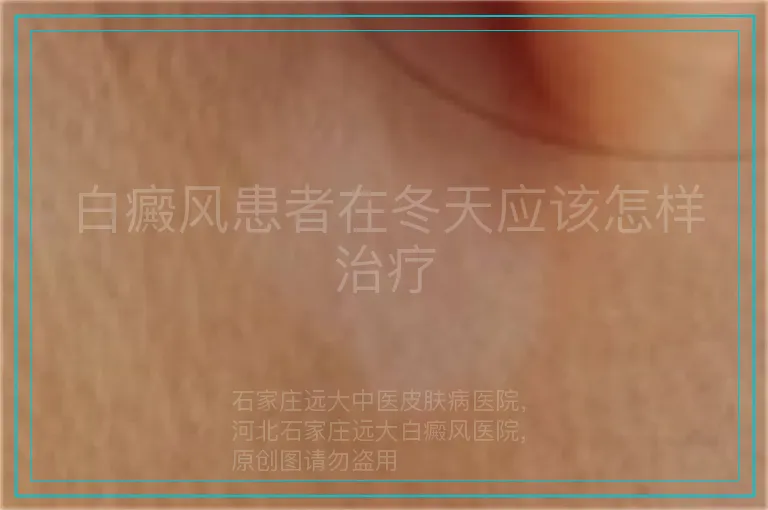 白癜风患者在冬天应该怎样治疗