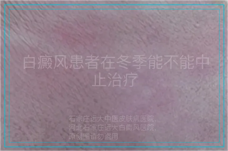 白癜风患者在冬季能不能中止治疗