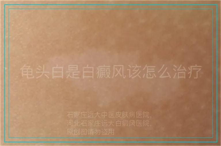 龟头白是白癜风该怎么治疗