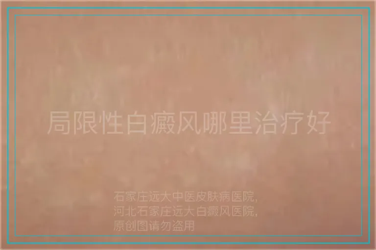 局限性白癜风哪里治疗好