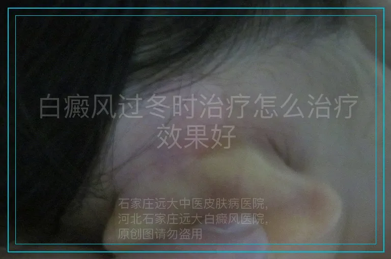 白癜风过冬时治疗怎么治疗效果好