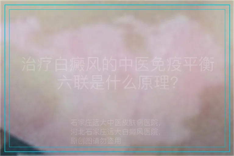 治疗白癜风的中医免疫平衡六联是什么原理?