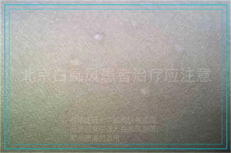 北京白癜风患者治疗应注意
