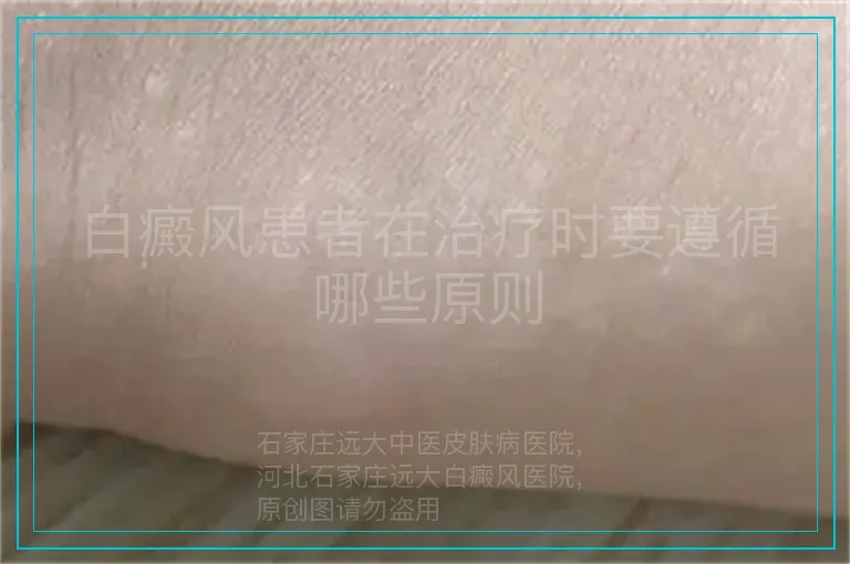 白癜风患者在治疗时要遵循哪些原则