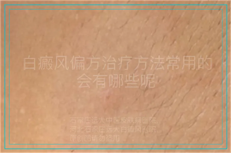 白癜风偏方治疗方法常用的会有哪些呢