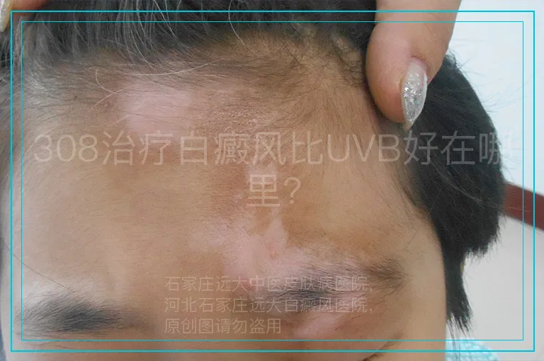 308治疗白癜风比UVB好在哪里?