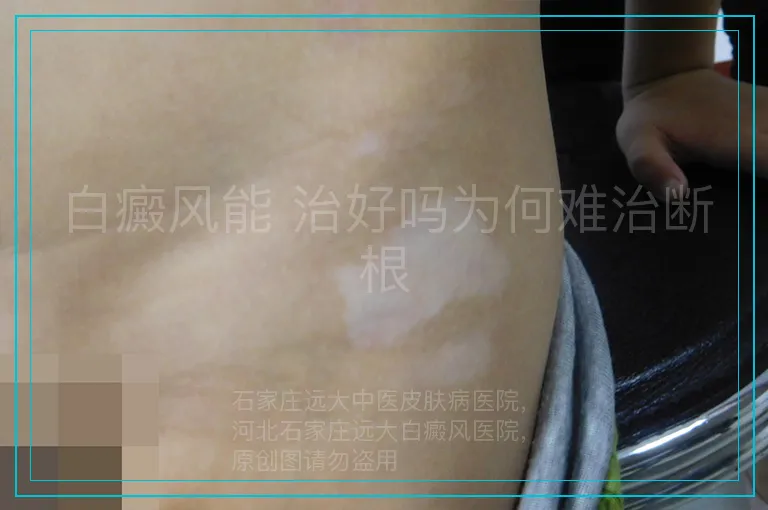 白癜风能 治好吗为何难治断根