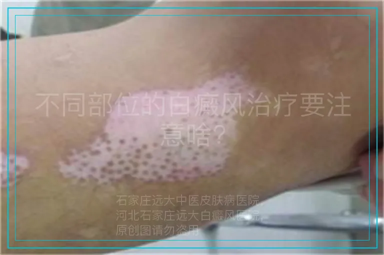 不同部位的白癜风治疗要注意啥?