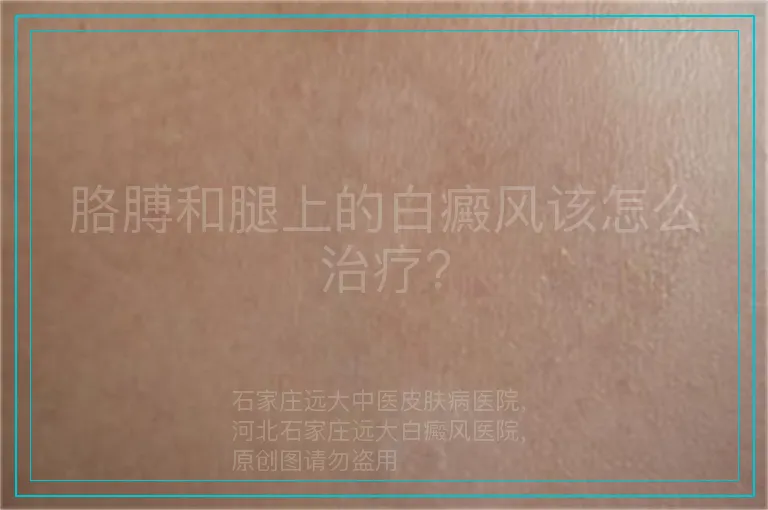 胳膊和腿上的白癜风该怎么治疗?