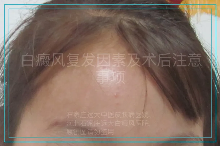 白癜风复发因素及术后注意事项