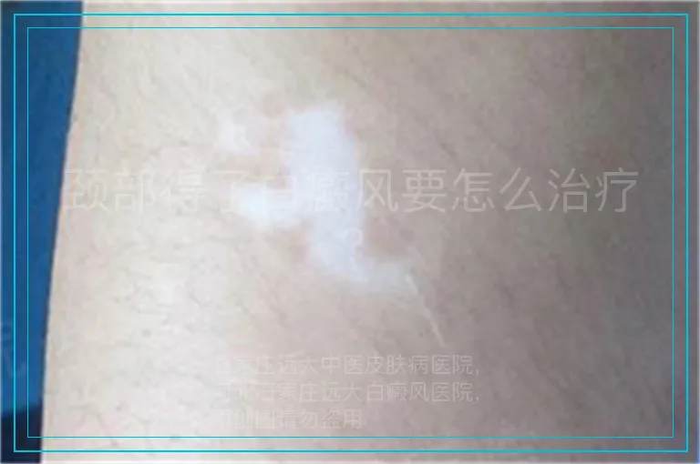 颈部得了白癜风要怎么治疗?