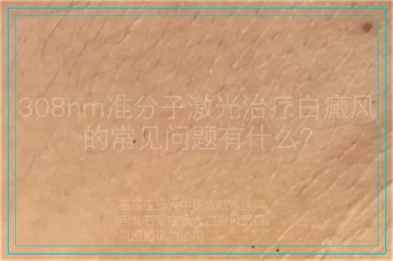 308nm准分子激光治疗白癜风的常见问题有什么?