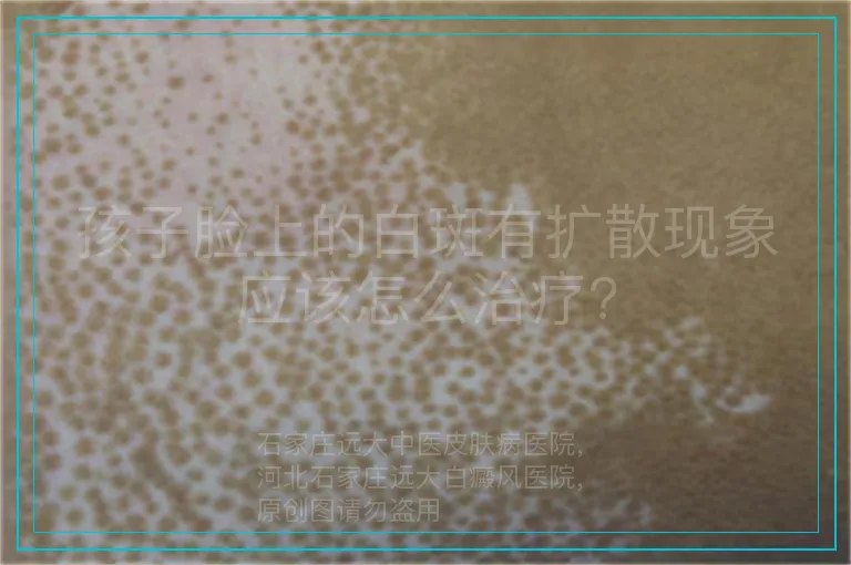孩子脸上的白斑有扩散现象应该怎么治疗?