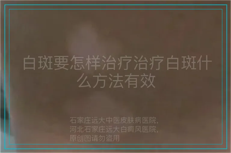 白斑要怎样治疗治疗白斑什么方法有效