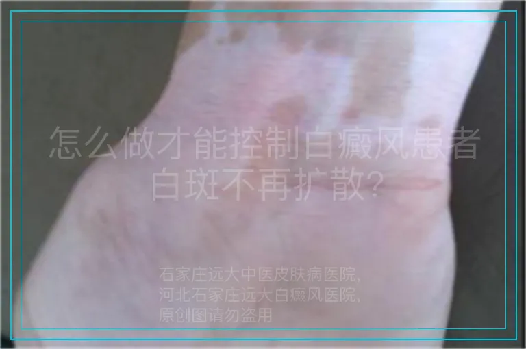 怎么做才能控制白癜风患者白斑不再扩散?