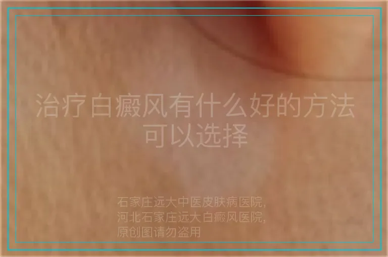 治疗白癜风有什么好的方法可以选择