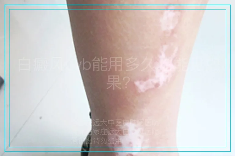 白癜风uvb能用多久才能见效果?