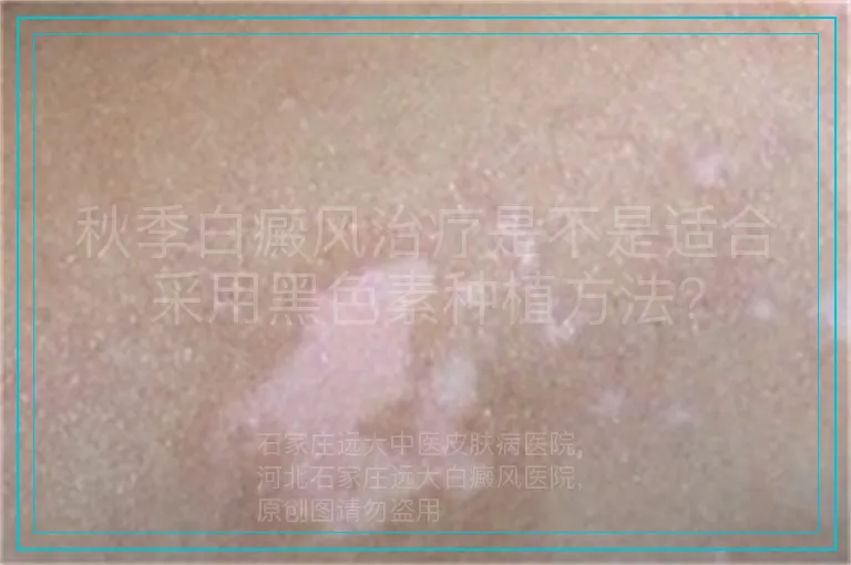 秋季白癜风治疗是不是适合采用黑色素种植方法?
