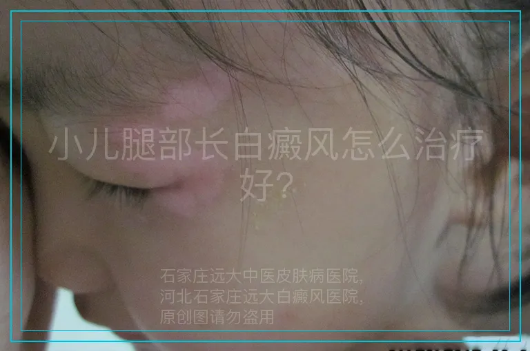 小儿腿部长白癜风怎么治疗好?