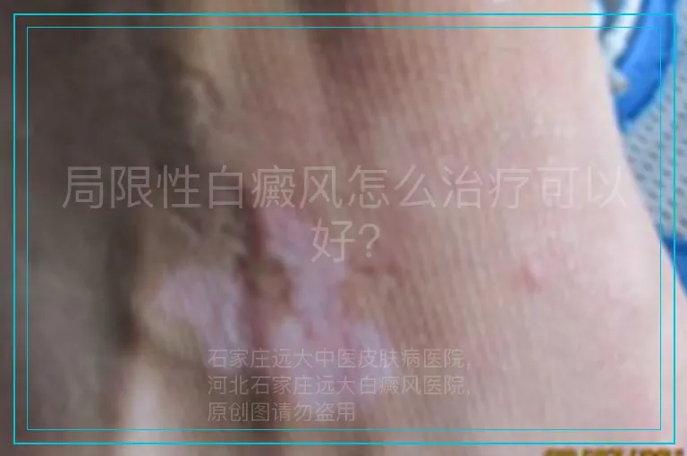 局限性白癜风怎么治疗可以好?