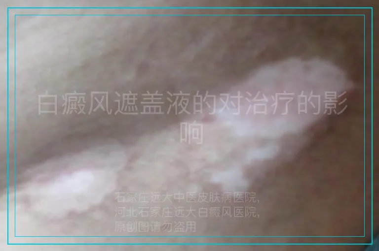 白癜风遮盖液的对治疗的影响