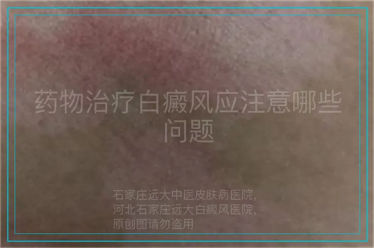 药物治疗白癜风应注意哪些问题