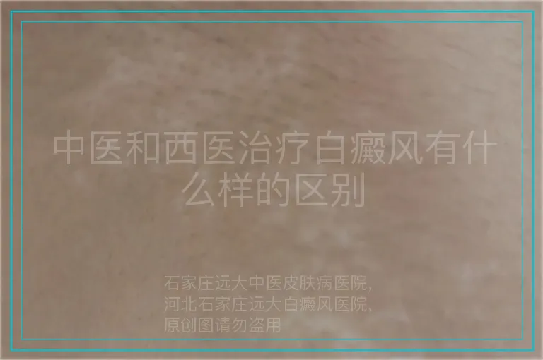 中医和西医治疗白癜风有什么样的区别