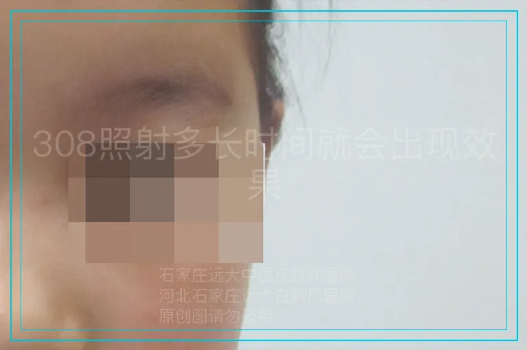 308照射多长时间就会出现效果