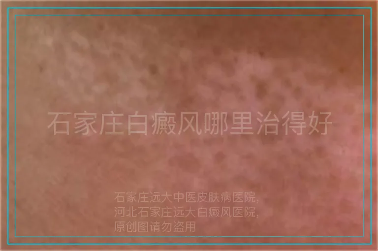 石家庄白癜风哪里治得好