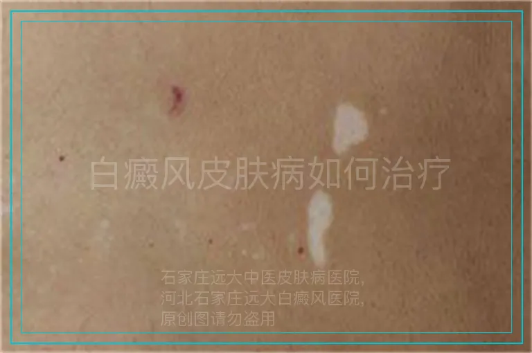 白癜风皮肤病如何治疗
