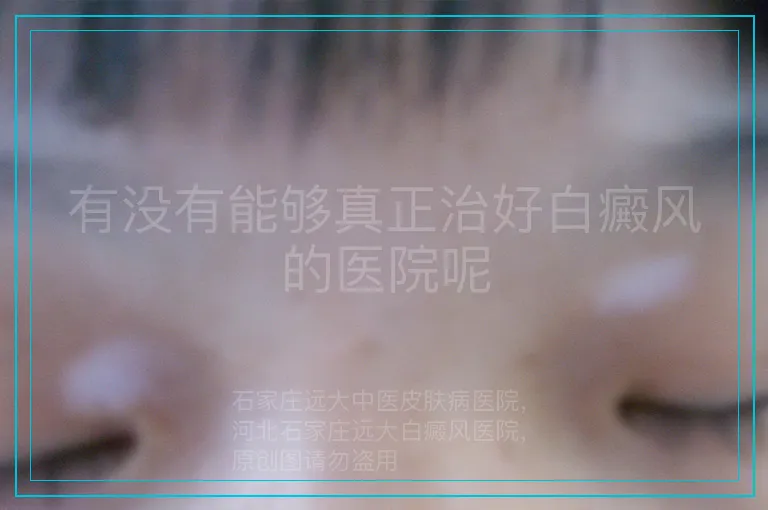有没有能够真正治好白癜风的医院呢