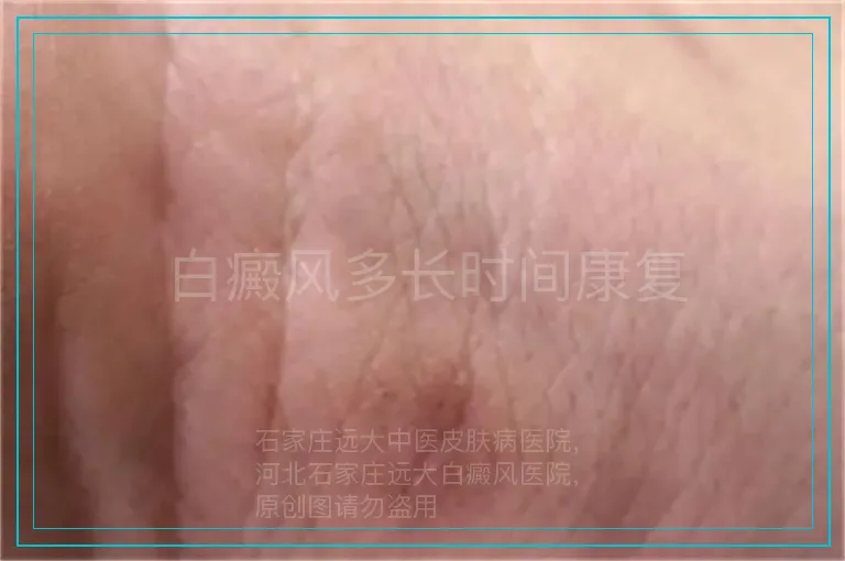 白癜风多长时间康复