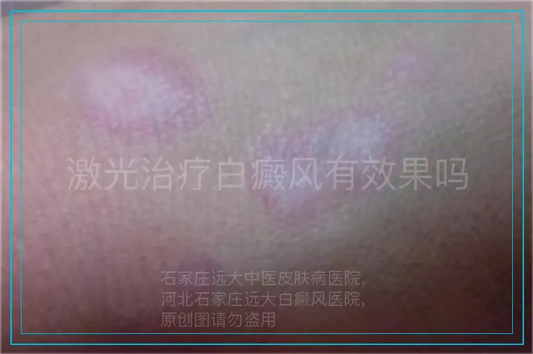 激光治疗白癜风有效果吗