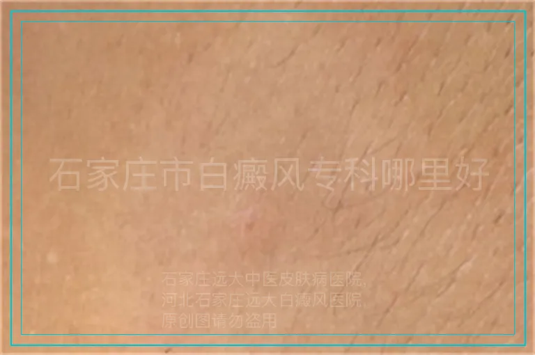 石家庄市白癜风专科哪里好