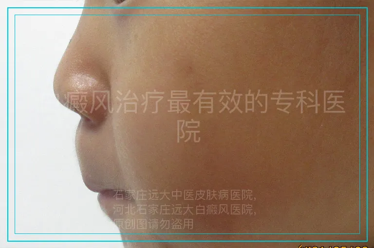 白癜风治疗最有效的专科医院