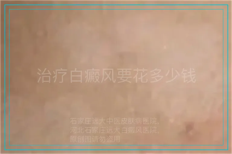 治疗白癜风要花多少钱