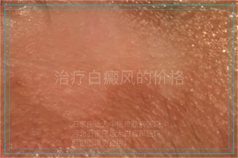 治疗白癜风的价格