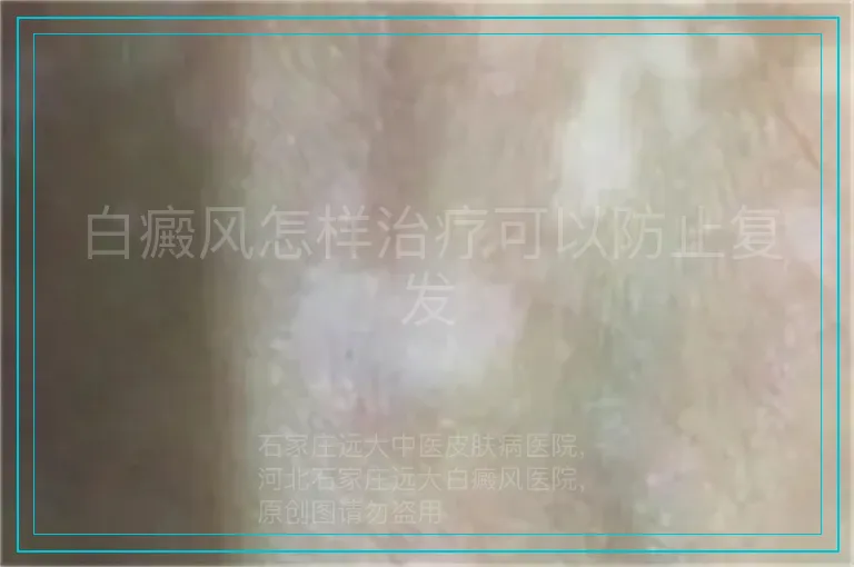 白癜风怎样治疗可以防止复发