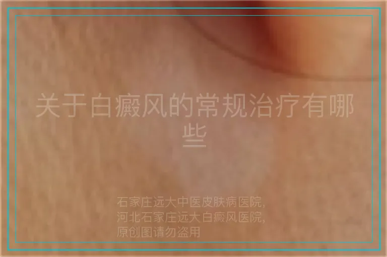 关于白癜风的常规治疗有哪些