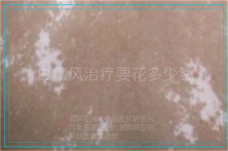 白癜风治疗要花多少钱