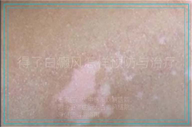 得了白癜风怎样预防与治疗