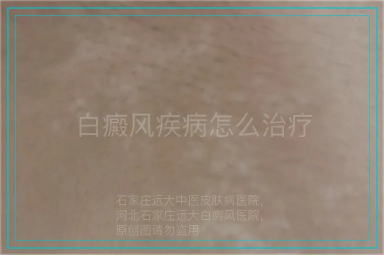 白癜风疾病怎么治疗