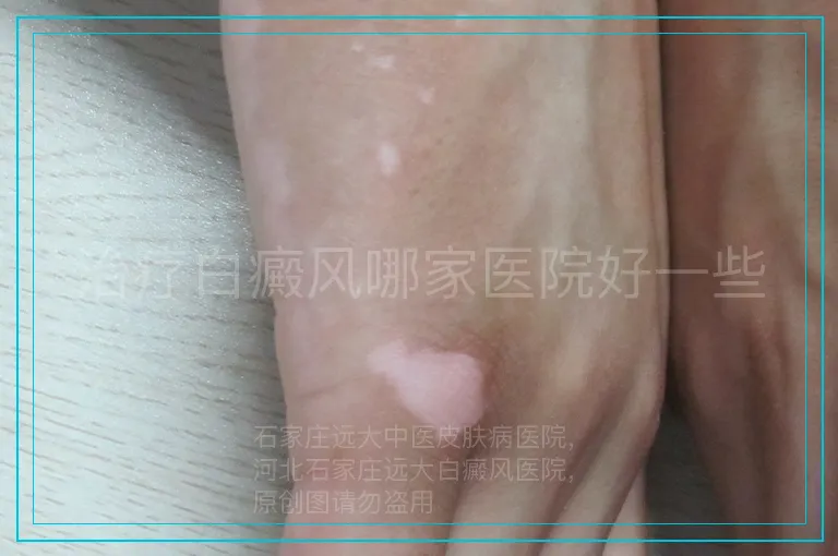 治疗白癜风哪家医院好一些